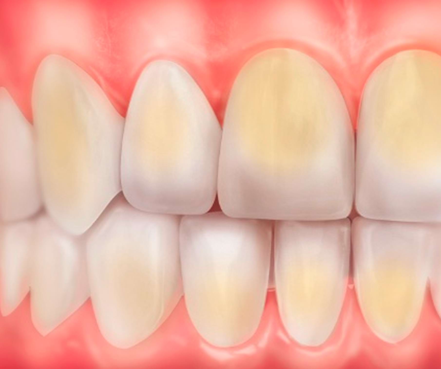 Close-up of teeth with yellow stains on them